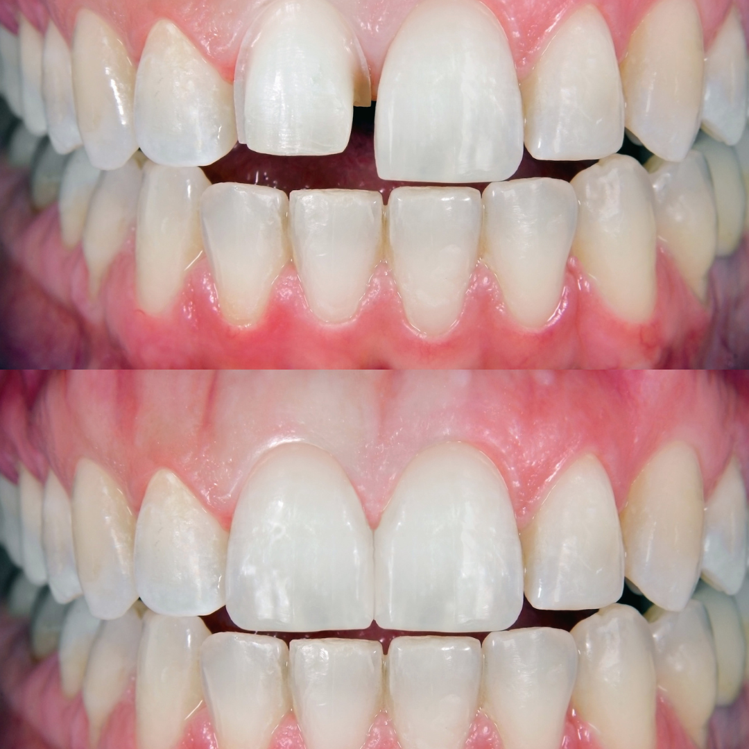 smile makeover before and after