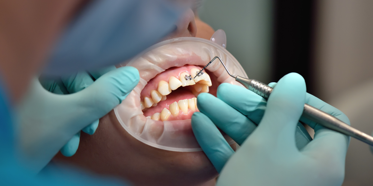 Dentist examining a patient's teeth during an orthodontic treatment procedure