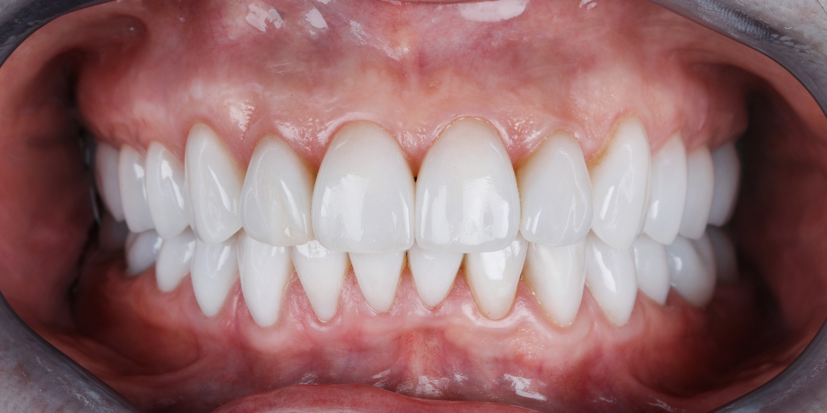Close-up of a bright, even smile after porcelain veneers cosmetic dentistry treatment